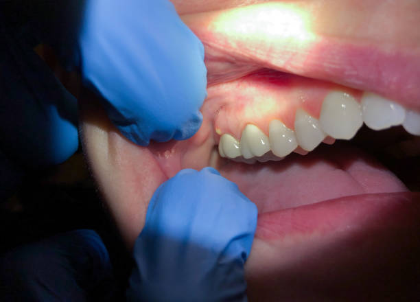 Best Emergency Cosmetic Dentistry (e.g., broken veneers) in Galls, IN